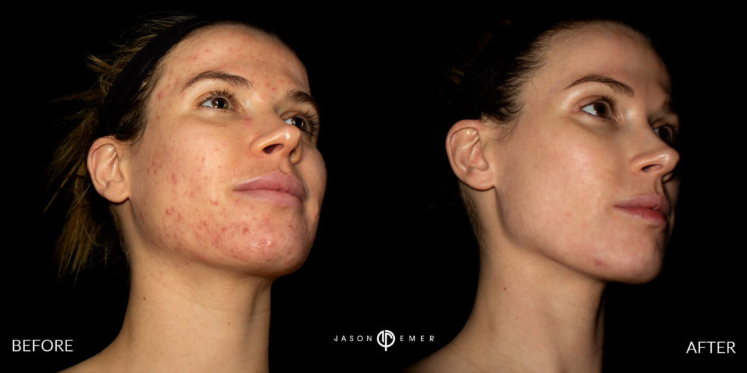 Acne Scar Laser Treatment Before and After Photo by Dr. Emer in West Hollywood California