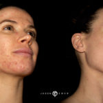 Acne Scar Laser Treatment Before and After Photo by Dr. Emer in West Hollywood California