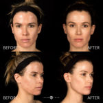 Acne Scar Laser Treatment Before and After Photo by Dr. Emer in West Hollywood California