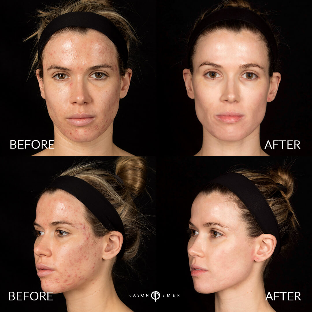 Acne Scar Laser Treatment Before and After Photo by Dr. Emer in West Hollywood California