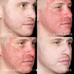 Laser Dermatology Before and After Photo by Dr. Emer in West Hollywood California