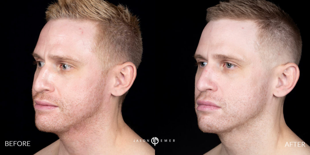 Laser Dermatology Before and After Photo by Dr. Emer in West Hollywood California