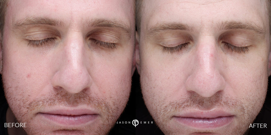 Laser Dermatology Before and After Photo by Dr. Emer in West Hollywood California