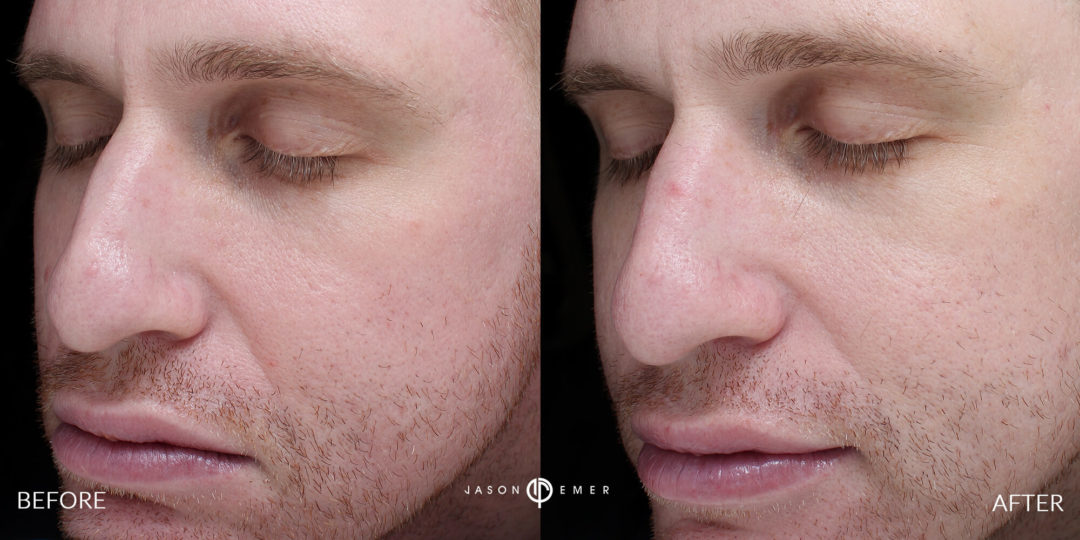 Laser Dermatology Before and After Photo by Dr. Emer in West Hollywood California