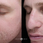 Laser Dermatology Before and After Photo by Dr. Emer in West Hollywood California