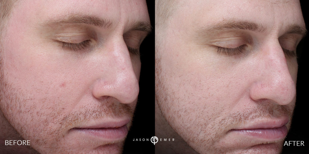 Laser Dermatology Before and After Photo by Dr. Emer in West Hollywood California