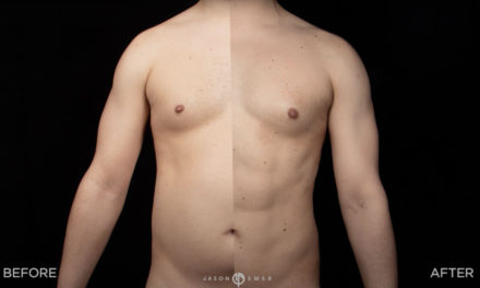 4D HIGH-DEF LIPOSCULPTURE FOR A CHISELED BODY