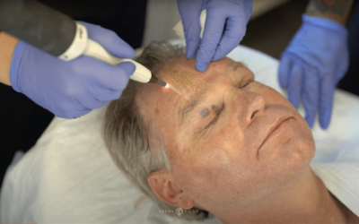 NON-SURGICAL FACELIFT WITH RENUVION RADIOFREQUENCY HELIUM PLASMA RESURFACING TECHNOLOGY