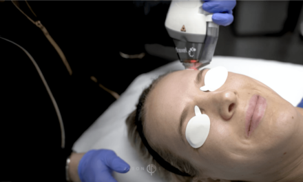 FRAXEL NON-ABLATIVE FRACTIONAL LASER WITH MICRONEEDLING AND PRP FOR FACIAL REJUVENTION, PREVENTATIVE AGING, ACNE SCARS, AND SUN DAMAGE