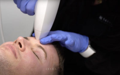 FRACTIONAL RADIO FREQUENCY SKIN RESURFACING