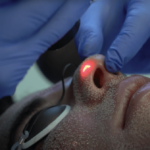 ACNE SCAR TREATMENTS | BELLAFILL, CO2 LASER RESURFACING, MICRONEEDLING