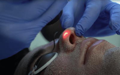 ACNE SCAR TREATMENTS | BELLAFILL, CO2 LASER RESURFACING, MICRONEEDLING