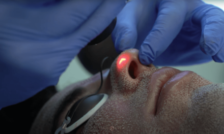 ACNE SCAR TREATMENTS | BELLAFILL, CO2 LASER RESURFACING, MICRONEEDLING