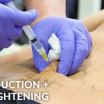 COMBINATION FAT REDUCTION & SKIN TIGHTENING