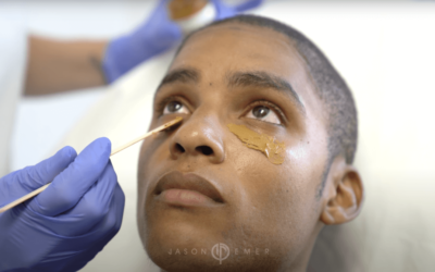 JAMAL – COSMELAN TREATMENT FOR ACNE SCARS & HYPERPIGMENTATION