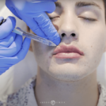 JULIAN O. – CHEMICAL PEEL