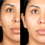 DERMAL FILLERS FOR A COUNTOURED FACE