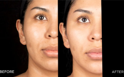 DERMAL FILLERS FOR A COUNTOURED FACE