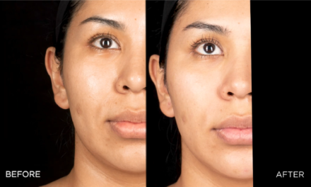 DERMAL FILLERS FOR A COUNTOURED FACE