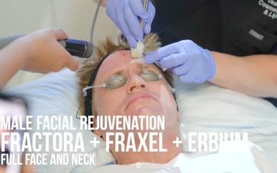 FRACTORA RF MICRONEEDLING, FRAXEL, AND ERBIUM LASERS