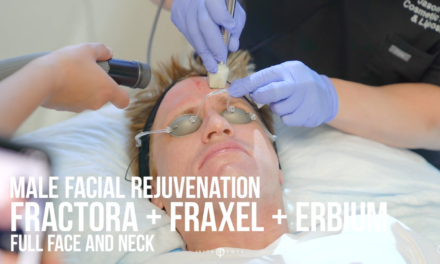 FRACTORA RF MICRONEEDLING, FRAXEL, AND ERBIUM LASERS