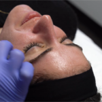 COMBINATION CHEMICAL PEEL FOR ACNE SCARS