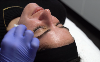 COMBINATION CHEMICAL PEEL FOR ACNE SCARS