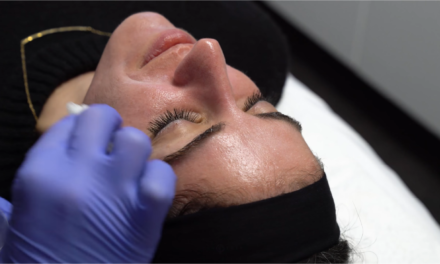 COMBINATION CHEMICAL PEEL FOR ACNE SCARS