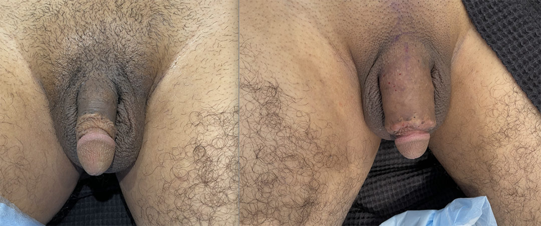 Penile Filler Before and After Photo by Dr. Emer and Dr. Sanan in West Hollywood California