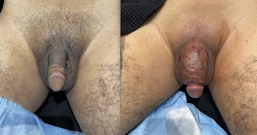 Penile Filler Before and After Photo by Dr. Emer and Dr. Sanan in West Hollywood California