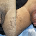 Penile Filler Before and After Photo by Dr. Emer and Dr. Sanan in West Hollywood California