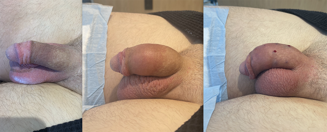 Penile Filler Before and After Photo by Dr. Emer and Dr. Sanan in West Hollywood California