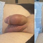 Penile Filler Before and After Photo by Dr. Emer and Dr. Sanan in West Hollywood California