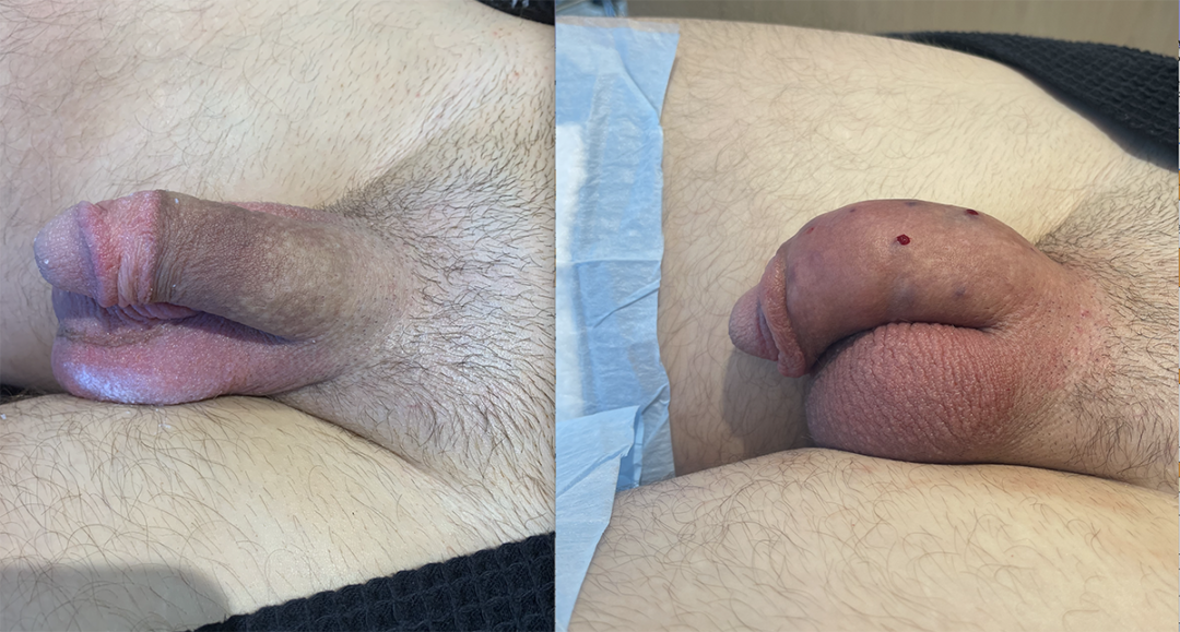 Penile Filler Before and After Photo by Dr. Emer and Dr. Sanan in West Hollywood California