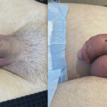 Penile Filler Before and After Photo by Dr. Emer and Dr. Sanan in West Hollywood California