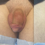 Penile Filler Before and After Photo by Dr. Emer and Dr. Sanan in West Hollywood California