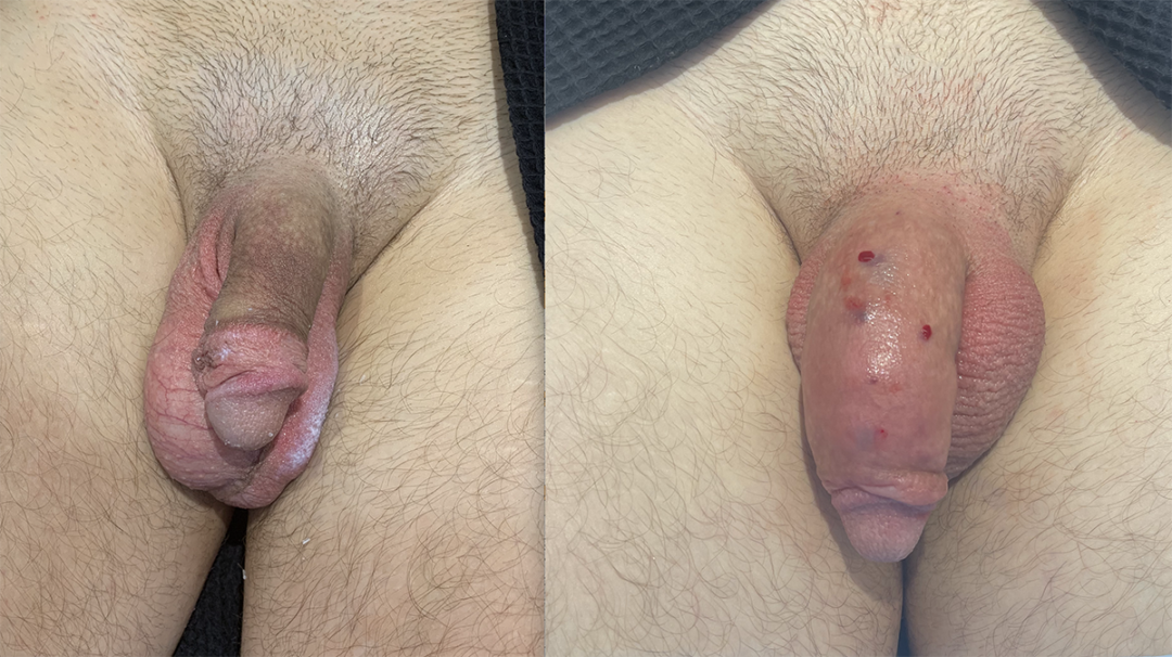 Penile Filler Before and After Photo by Dr. Emer and Dr. Sanan in West Hollywood California