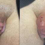 Penile Filler Before and After Photo by Dr. Emer and Dr. Sanan in West Hollywood California