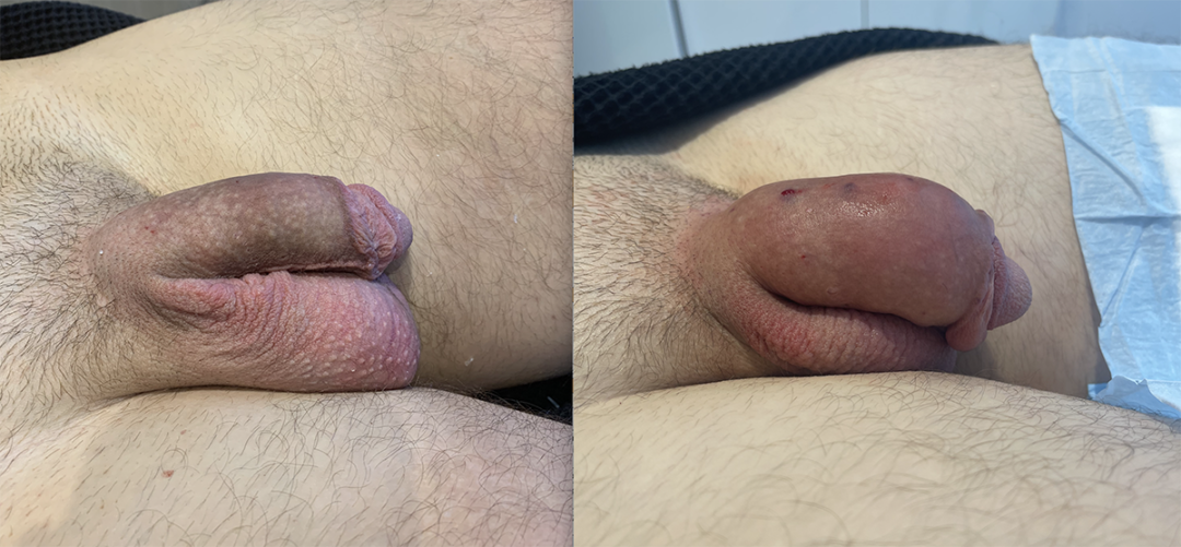 Penile Filler Before and After Photo by Dr. Emer and Dr. Sanan in West Hollywood California