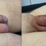 Penile Filler Before and After Photo by Dr. Emer and Dr. Sanan in West Hollywood California