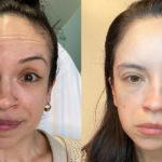 Botox Before and After Photo by Dr. Emer and Dr. Sanan in West Hollywood California