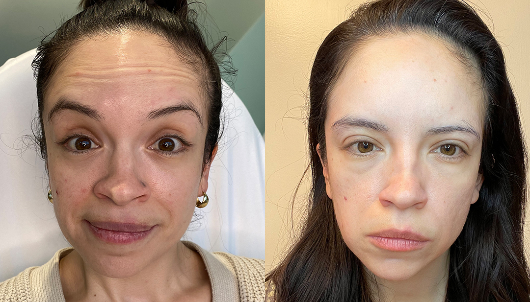 Botox Before and After Photo by Dr. Emer and Dr. Sanan in West Hollywood California