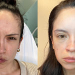 Botox Before and After Photo by Dr. Emer and Dr. Sanan in West Hollywood California