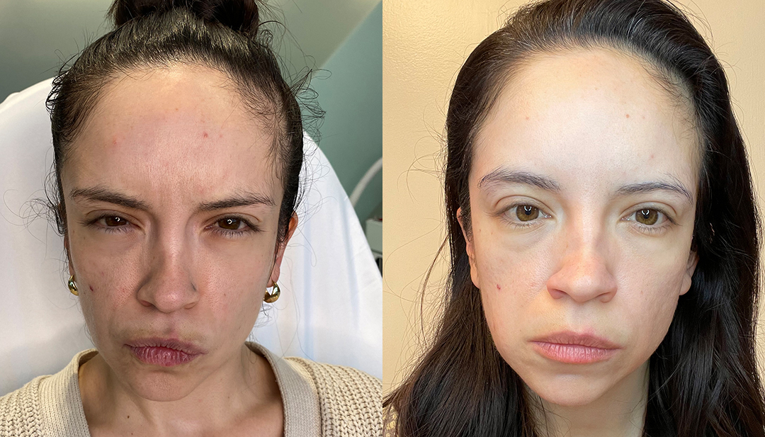 Botox Before and After Photo by Dr. Emer and Dr. Sanan in West Hollywood California