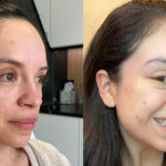 Botox Before and After Photo by Dr. Emer and Dr. Sanan in West Hollywood California