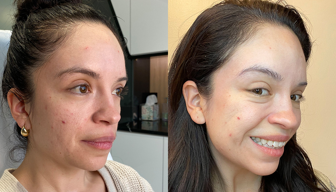 Botox Before and After Photo by Dr. Emer and Dr. Sanan in West Hollywood California