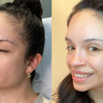 Botox Before and After Photo by Dr. Emer and Dr. Sanan in West Hollywood California