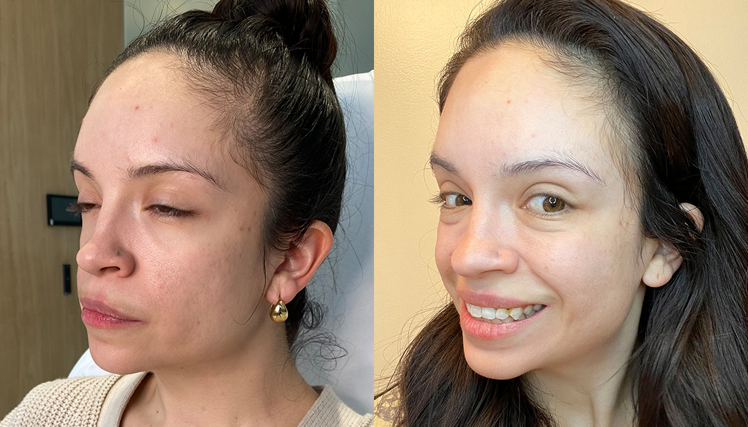 Botox Before and After Photo by Dr. Emer and Dr. Sanan in West Hollywood California