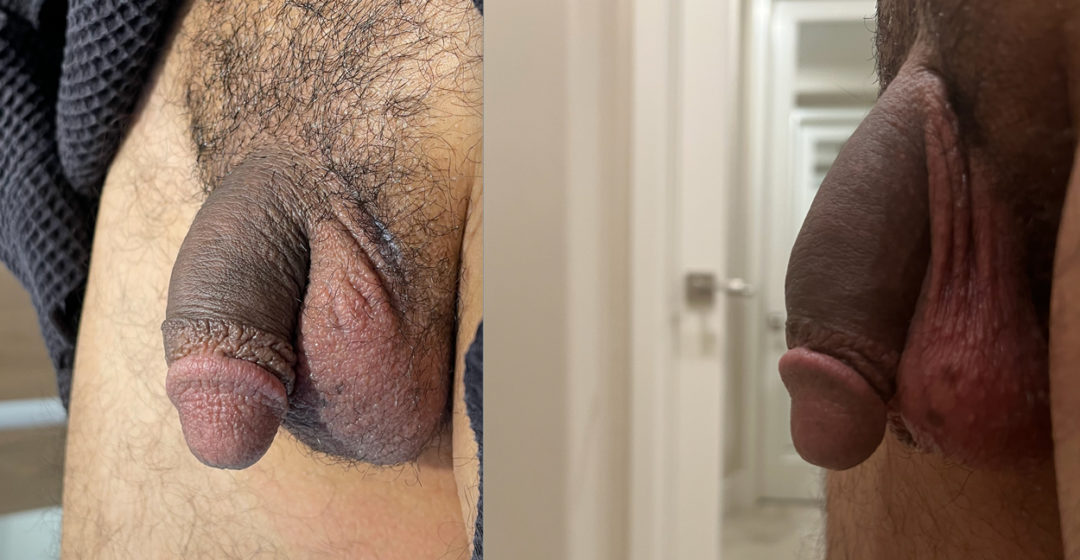 Penile Filler patient - selfie at 3 weeks on right side