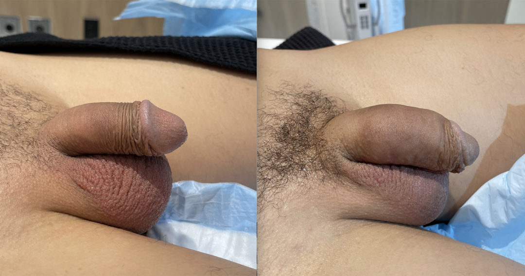 Penile Filler Before and After Photo by Dr. Emer in West Hollywood, CA